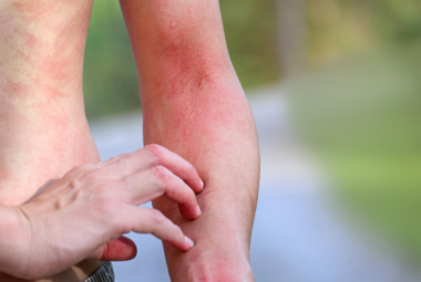 Preservative Sensitivity