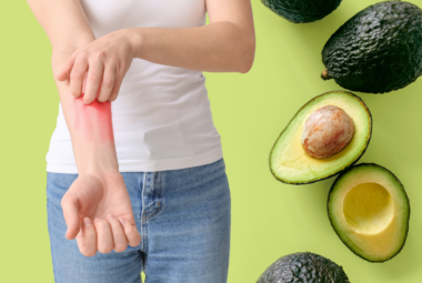 Allergic Reaction to Avocado